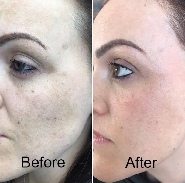 PRP Skin Rejuvenation